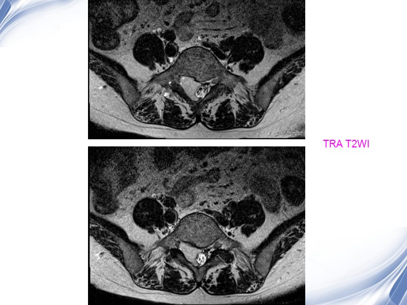 医学影像-病例随访椎管病变影像诊断.ppt_第3页