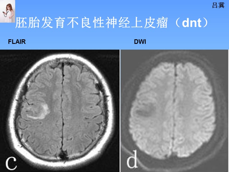 医影在线--CNS疾病影像图库(2).ppt_第3页