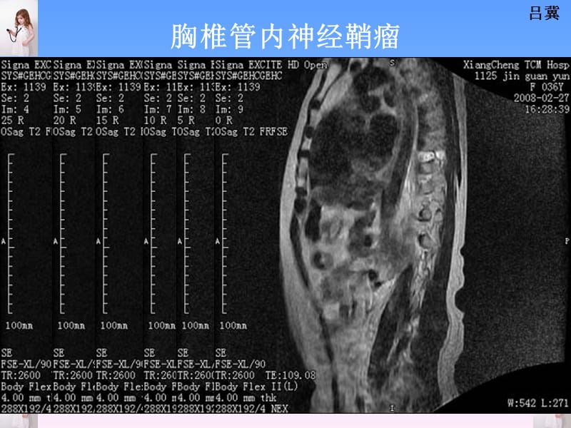 医影在线--CNS疾病MRI诊断(4).ppt_第2页
