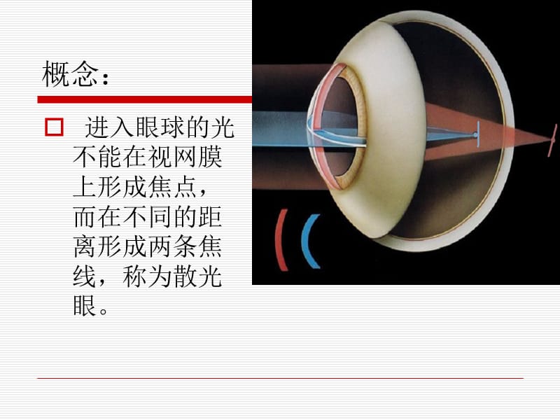 稍微深入讲述散光眼.ppt_第2页