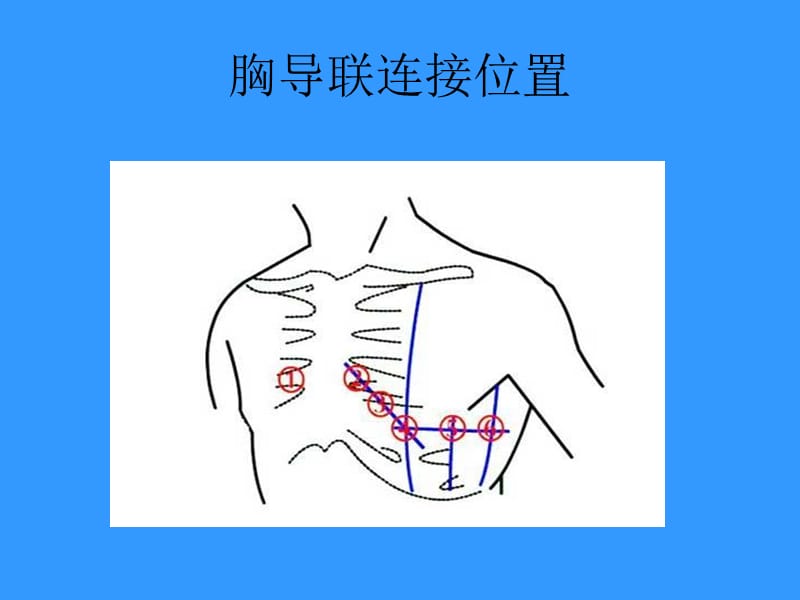 执业医师技能考试—心电图.ppt_第3页