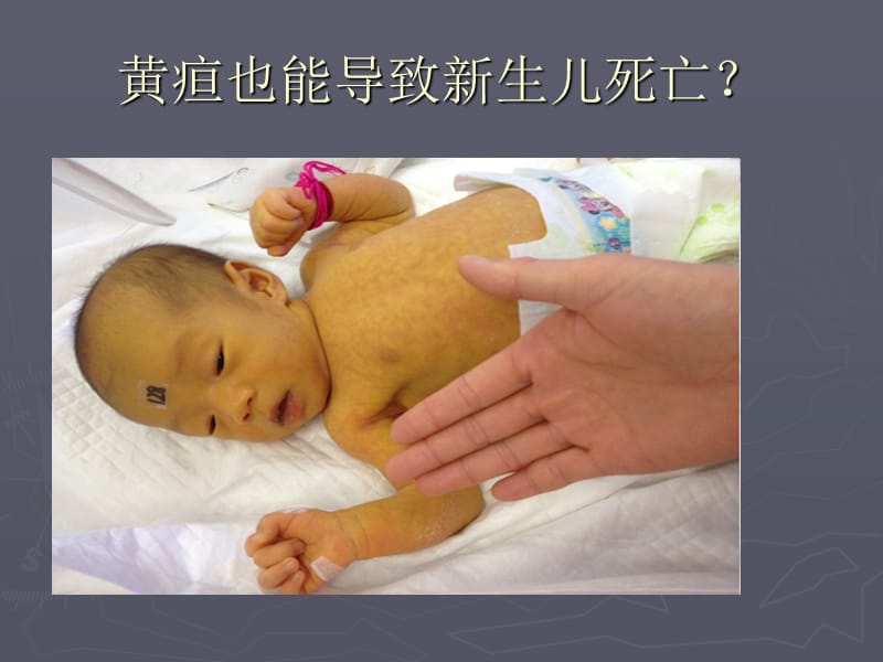 新生儿胆红素脑病.ppt_第2页