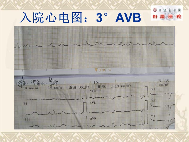 起搏器术后胸腔包裹积液.ppt_第3页