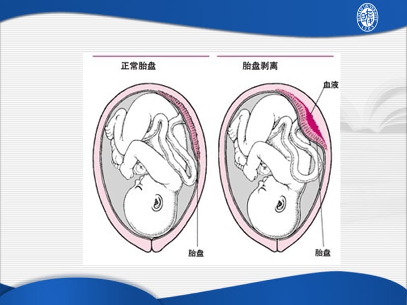 胎盘早剥.ppt_第2页