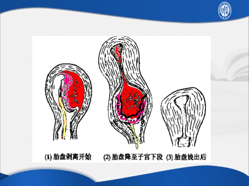 胎盘早剥.ppt_第3页