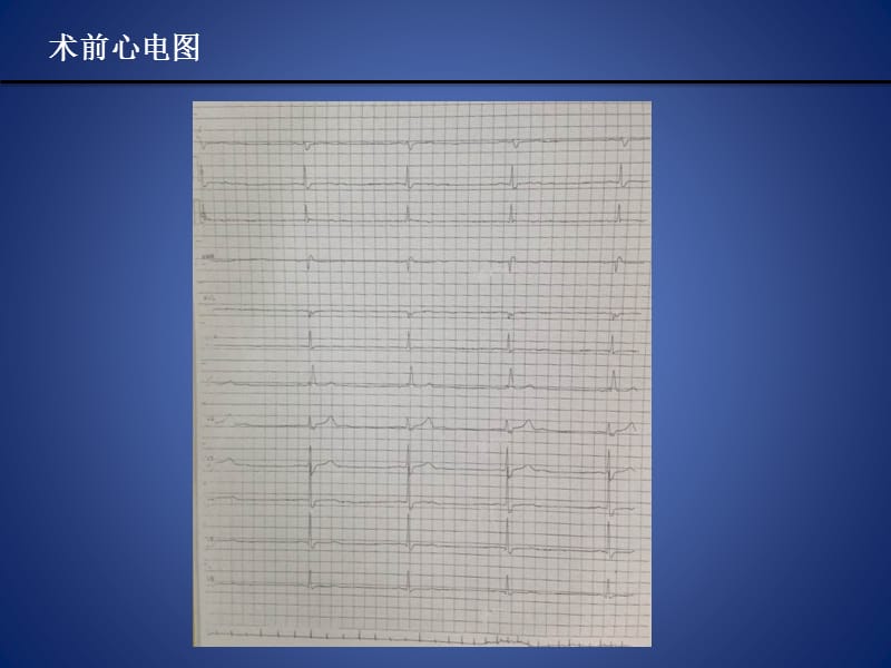 永存左上腔起搏器植入术.ppt_第3页