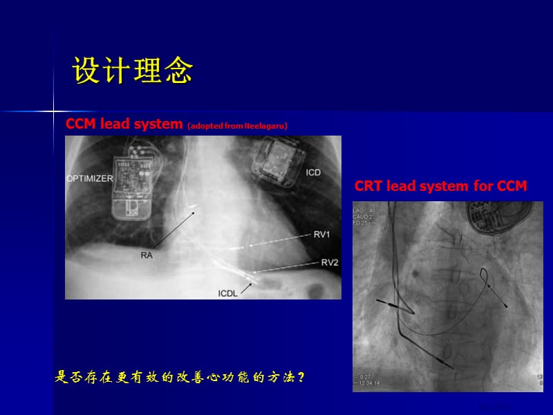 通过CRT-D系统心脏收缩力调制CCM的临床研究.ppt_第3页