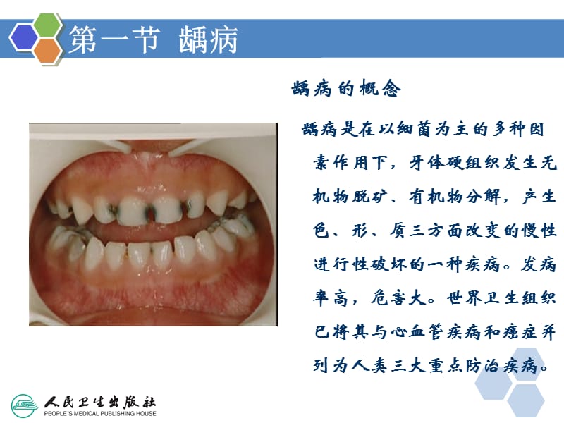 牙体牙周组织疾病课件.ppt_第3页