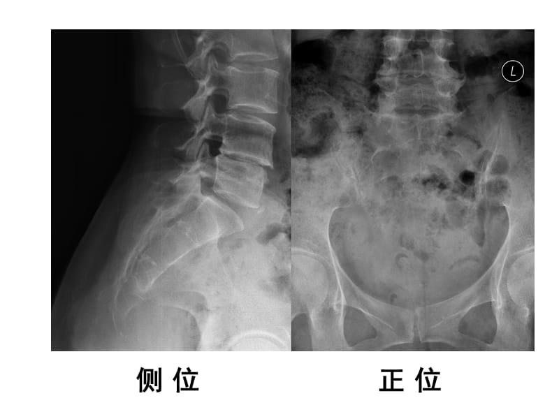 直肠癌骨转移.ppt_第3页