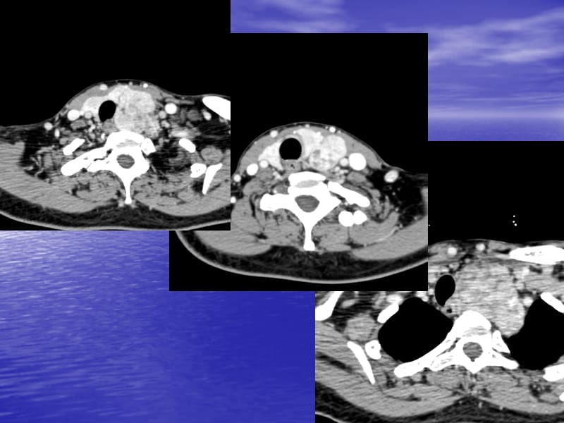胸内甲状腺肿.ppt_第3页