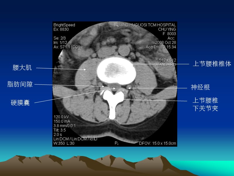 腰椎CT诊断.ppt_第3页