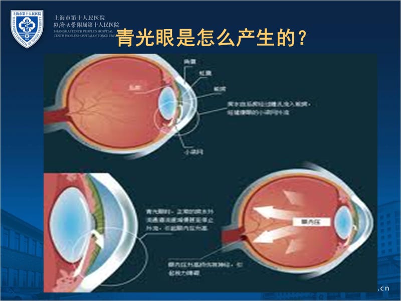 青光眼的药物治疗.ppt_第3页