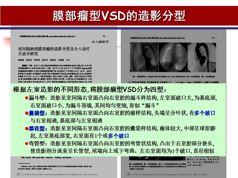 膜部瘤型VSD介入治疗策略.ppt_第3页