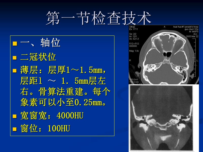 耳-颞骨病变的CT诊断鼻窦.ppt_第2页