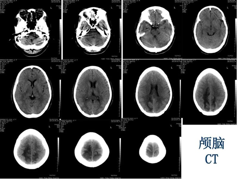 可逆性后部白质脑病综合征(RPLS)_图文.ppt.ppt_第2页