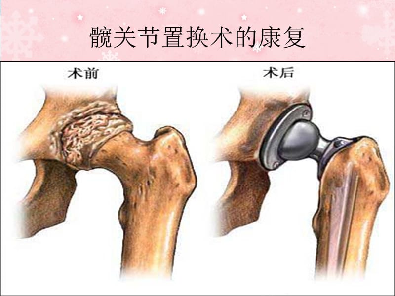 髋关节置换术的康.ppt_第1页