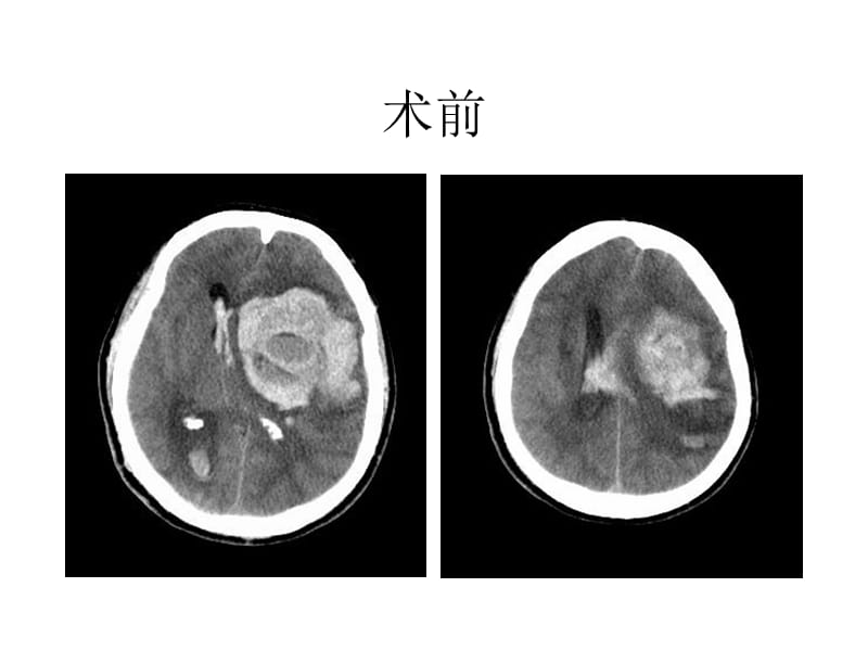 脑外科教学查房.ppt_第2页