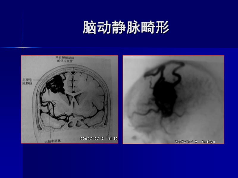 脑血管畸形的外科治疗.ppt_第2页