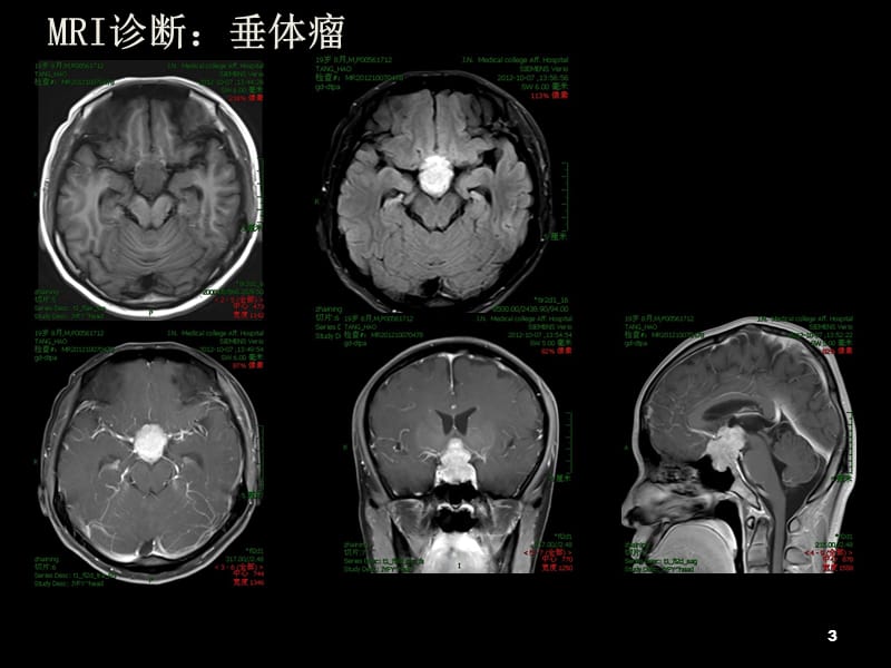 颅底少见占位性病变.ppt_第3页