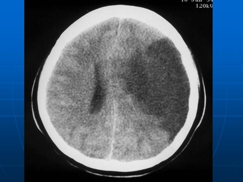 脑梗死与颅内出血出血CT影像.ppt_第2页