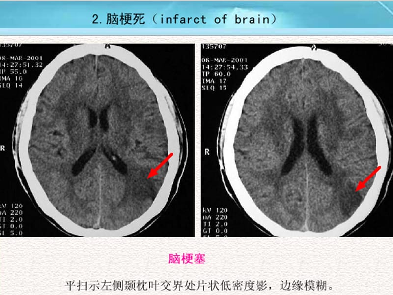 脑梗死与颅内出血出血CT影像.ppt_第3页