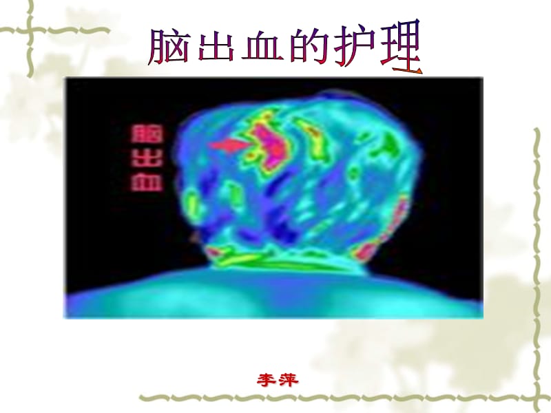 脑出血讲课.ppt_第1页