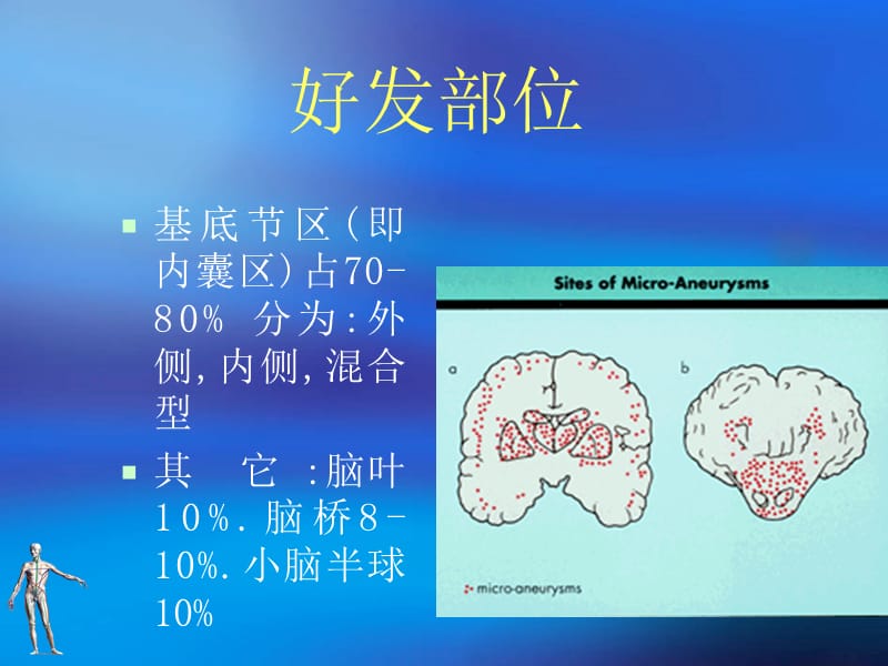 脑出血12.ppt_第3页