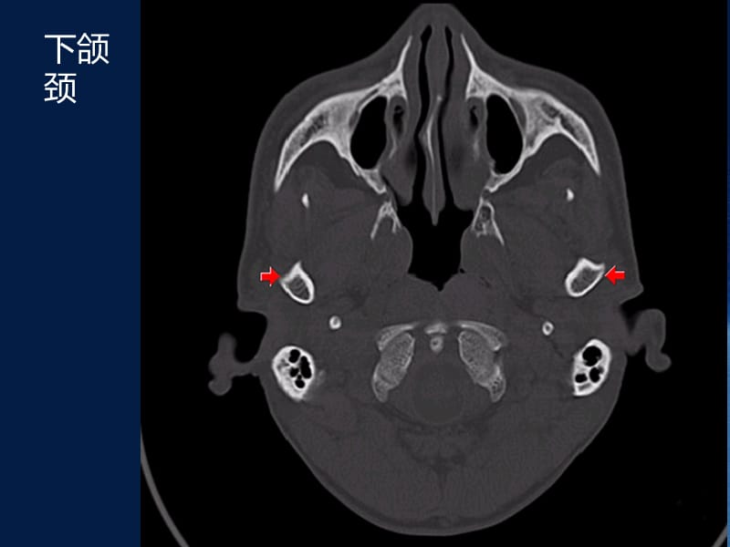 颅底骨质解剖.ppt_第3页