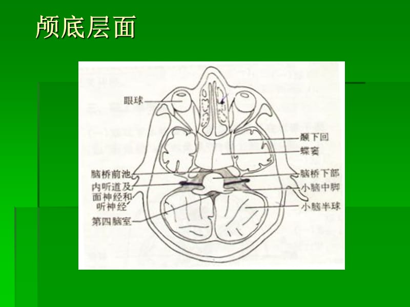 脑-头颅CT示意图.ppt_第2页