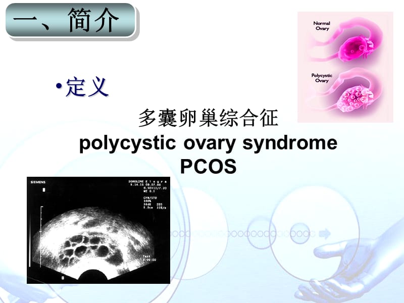 多囊卵巢综合征PCOS .ppt_第3页