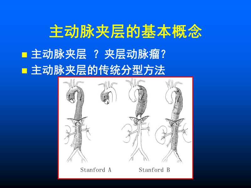 主动脉夹层的外科分型及治疗对策.ppt_第2页