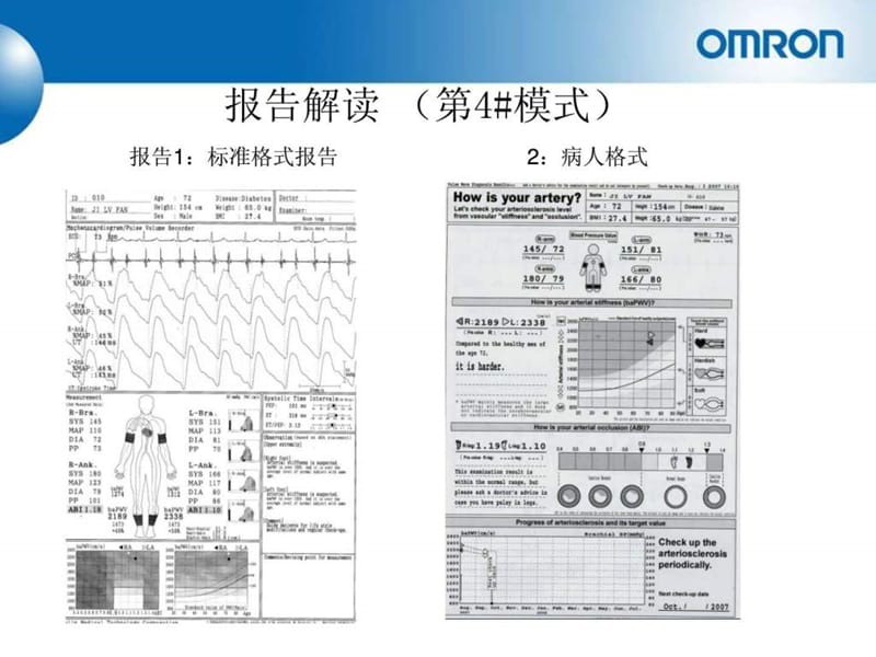 动脉硬化报告解读手册(康华).ppt_第2页