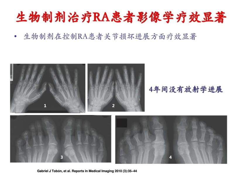 脊柱关节病的目标治疗与目标治疗——刘毅主任.ppt_第3页