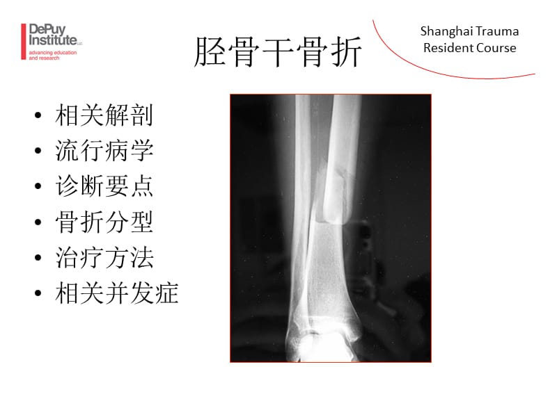 胫骨干骨折包括骨筋膜室综合征ppt课件.ppt_第3页