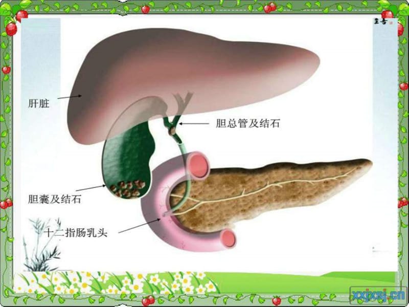 护理查房-胆总管结石.ppt_第2页