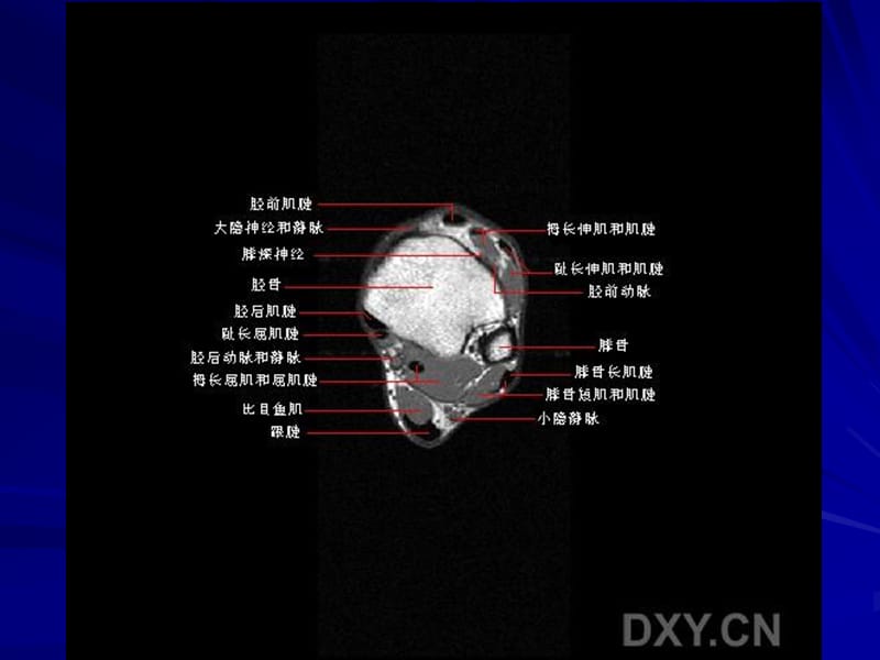 正常踝关节mr解剖ppt课件.ppt_第2页