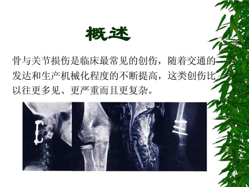 骨折后的康复(1).ppt_第3页