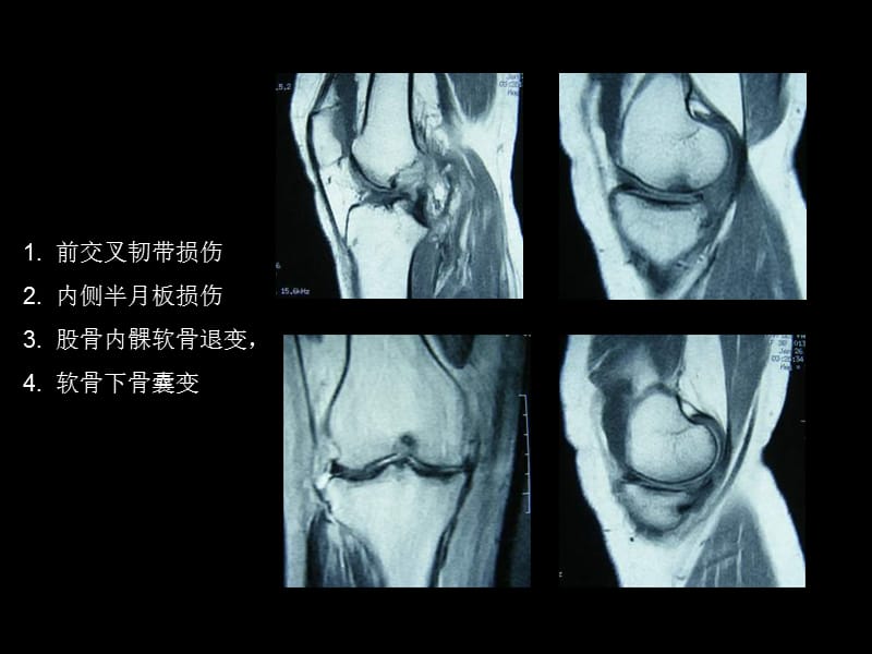 内侧半月板移植二次镜检1例报道.ppt_第3页