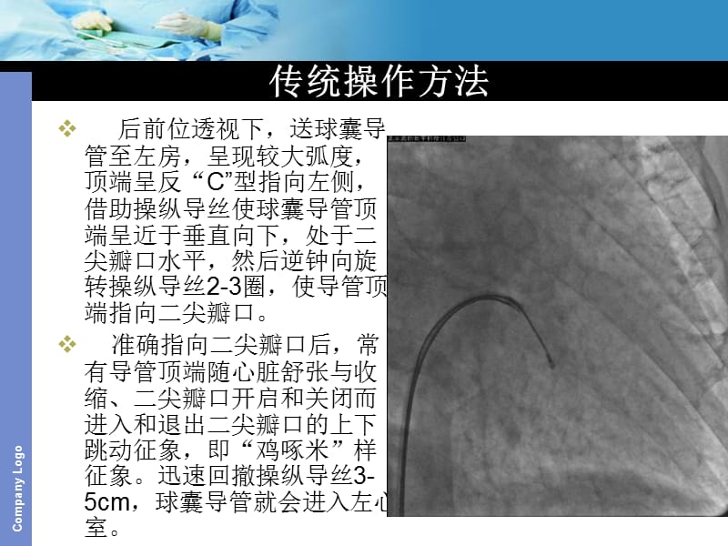 球囊通过严重二尖瓣狭窄的技巧.ppt_第3页