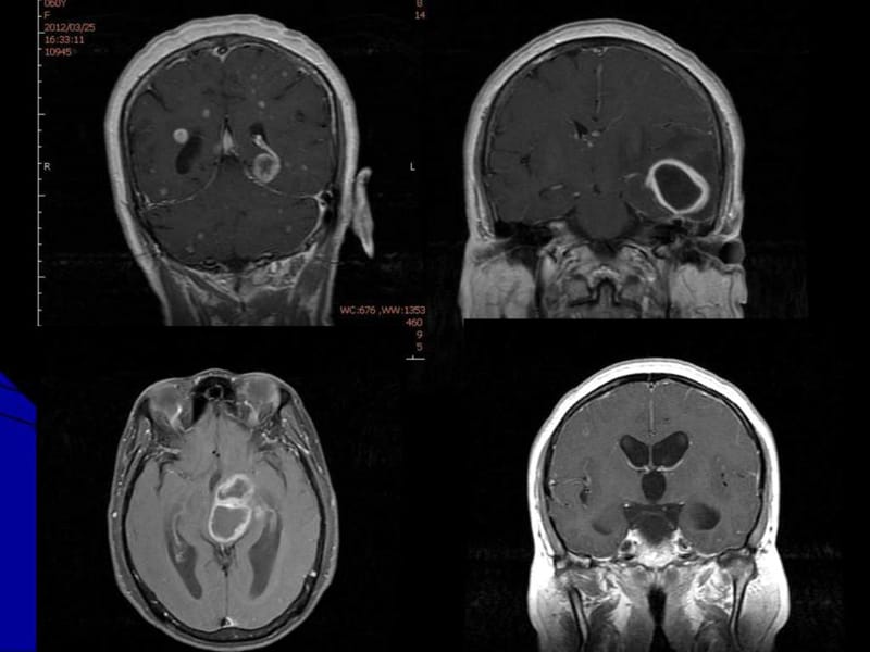 脑脓肿的影裾锒蟔图文.ppt.ppt_第2页