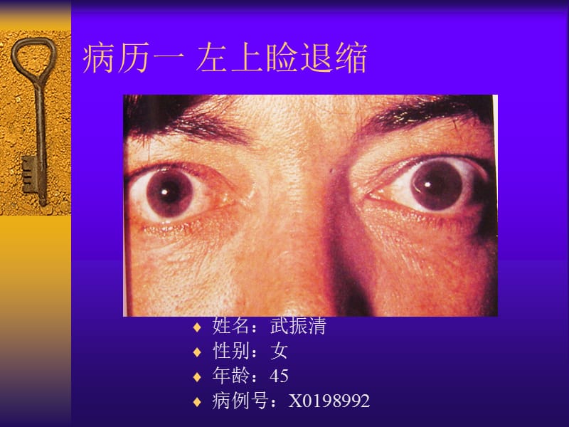 眼睑退缩的手术治疗.ppt_第2页