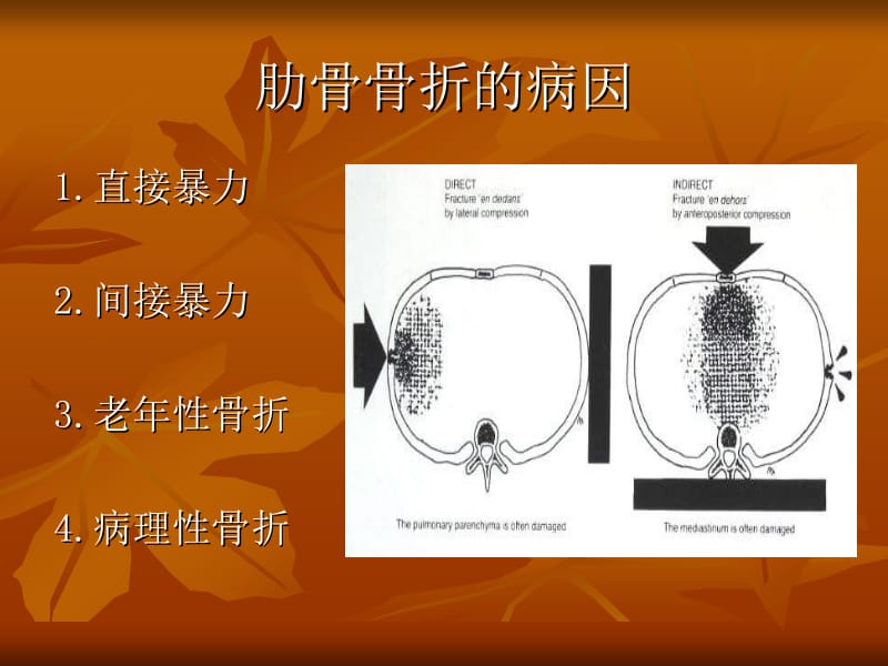 肋骨接骨板的临床应用.ppt_第2页