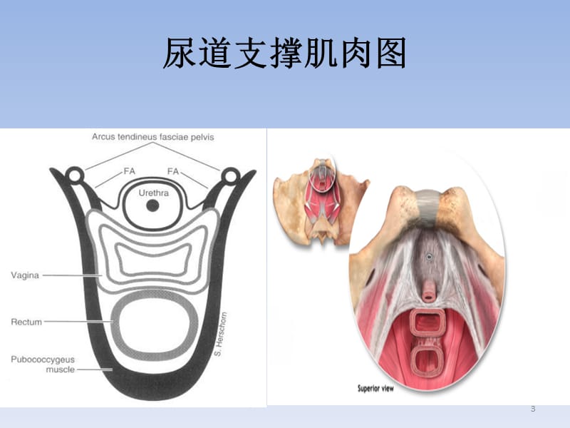 sling手术方式选择的思考.ppt_第3页