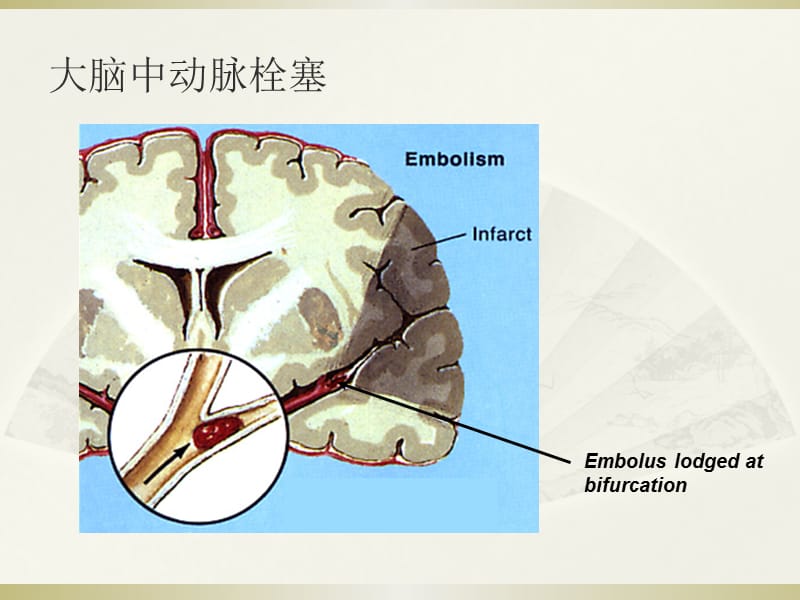 中风康复.ppt_第3页