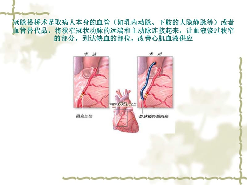 非体循下冠脉搭桥术的麻醉.ppt_第2页