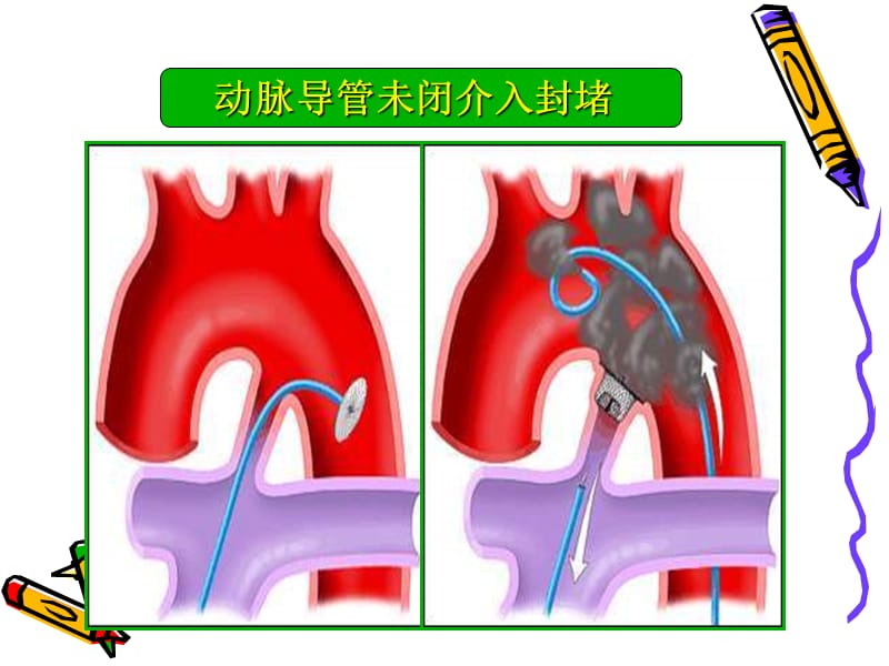 从介入医生角度：论先心病合理化治疗_张玉顺.ppt_第3页