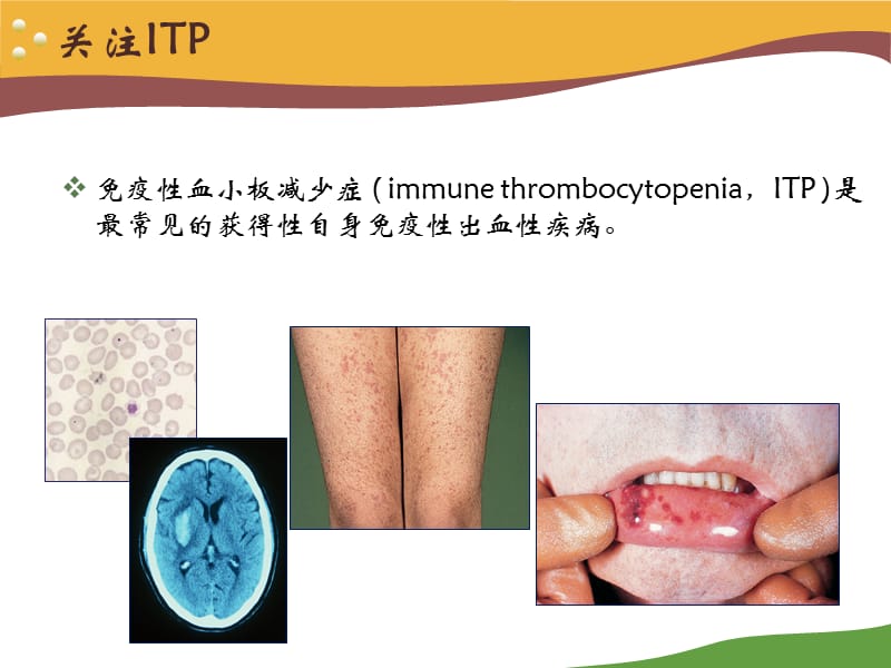 侯明-ITP中国专家共识修订版.ppt_第2页