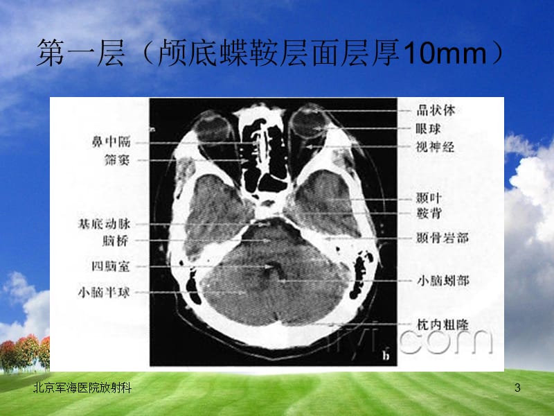 《颅脑CT影像学》PPT课件.ppt_第3页