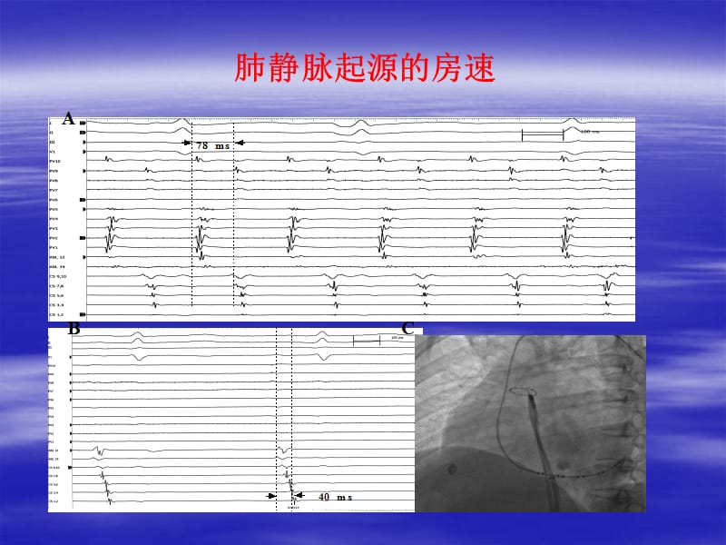 特殊部位房速的标测与消融.ppt_第3页