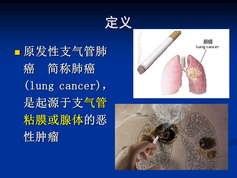 原发性支气管肺癌.ppt_第3页